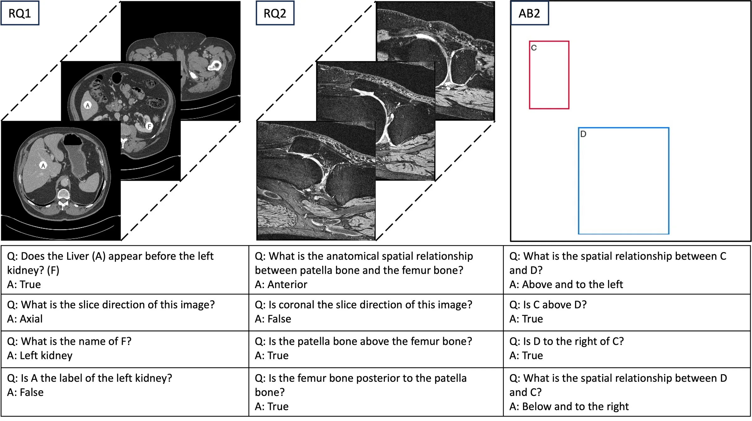 Sample question-answer pairs from MIS-Ground. For each 2D or 3D vision input (top), multiple questions are generated (bottom). Video VLMs display the ability to discern anatomical structure relationships across slices (RQ1); they prefer anatomical direction terms like anterior (RQ2); and they are capable of abstract spatial reasoning (AB2). Note: the CT image is shown in axial RAS standard viewing orientation, whereas the MRI is shown in sagittal RAS storage mode.